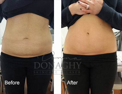 Body Contouring Before and After